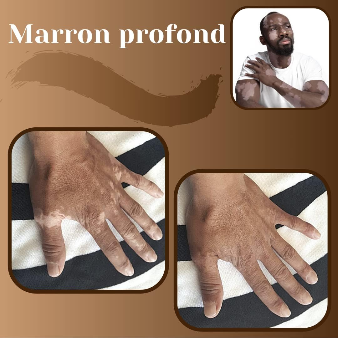 Zebratan Deep Brown, Vitiligo Makeup Lotion