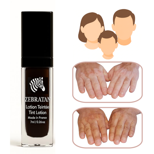 Zebratan Beige Clair – Lotion de maquillage mixte du vitiligo pour visage et corps