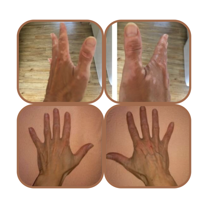 VITISTOP Gel crème 2X 50 ml - Régulateur pour Vitiligo, Soin Cosmétique Uniformisant, Pour Peaux dépigmentées, Avec Cuivre et Zinc, Babchi (bakuchiol), repigmentation progressive