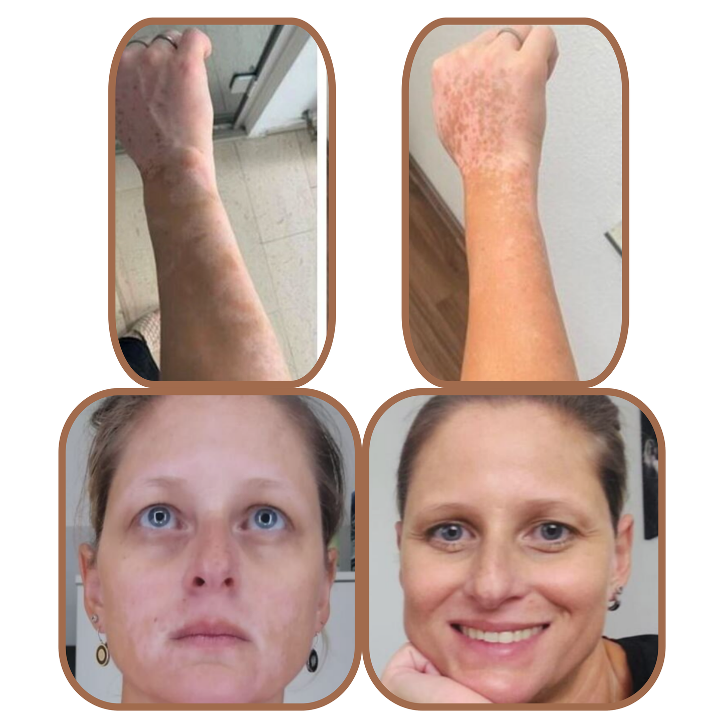 VITISTOP Gel crème 2X 50 ml - Régulateur pour Vitiligo, Soin Cosmétique Uniformisant, Pour Peaux dépigmentées, Avec Cuivre et Zinc, Babchi (bakuchiol), repigmentation progressive