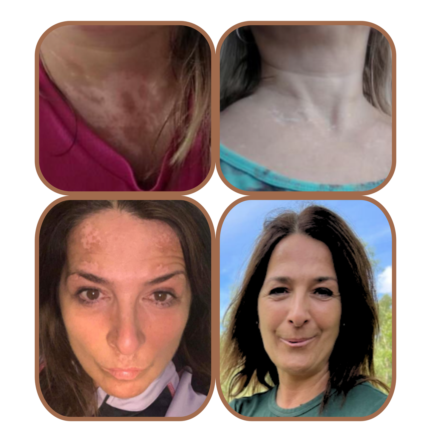 VITISTOP Gel crème 2X 50 ml - Régulateur pour Vitiligo, Soin Cosmétique Uniformisant, Pour Peaux dépigmentées, Avec Cuivre et Zinc, Babchi (bakuchiol), repigmentation progressive