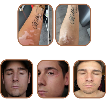 VITISTOP® Complément Alimentaire 180 gélules Cure 6 mois – Synergie nutritionnelle pour les peaux sujettes à la dépigmentation, vitiligo, taches blanches sur la peau, repigmentation progressive