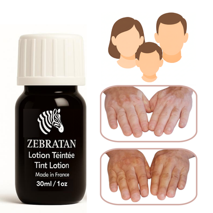 melanotan for vitiligo & Tanning Injections: Safe or Risky? Changes in Oral Mucosa Associated